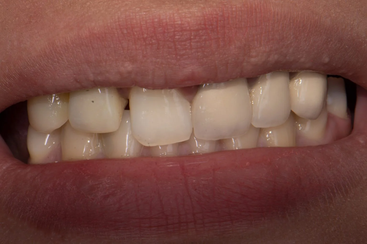 Before treatment