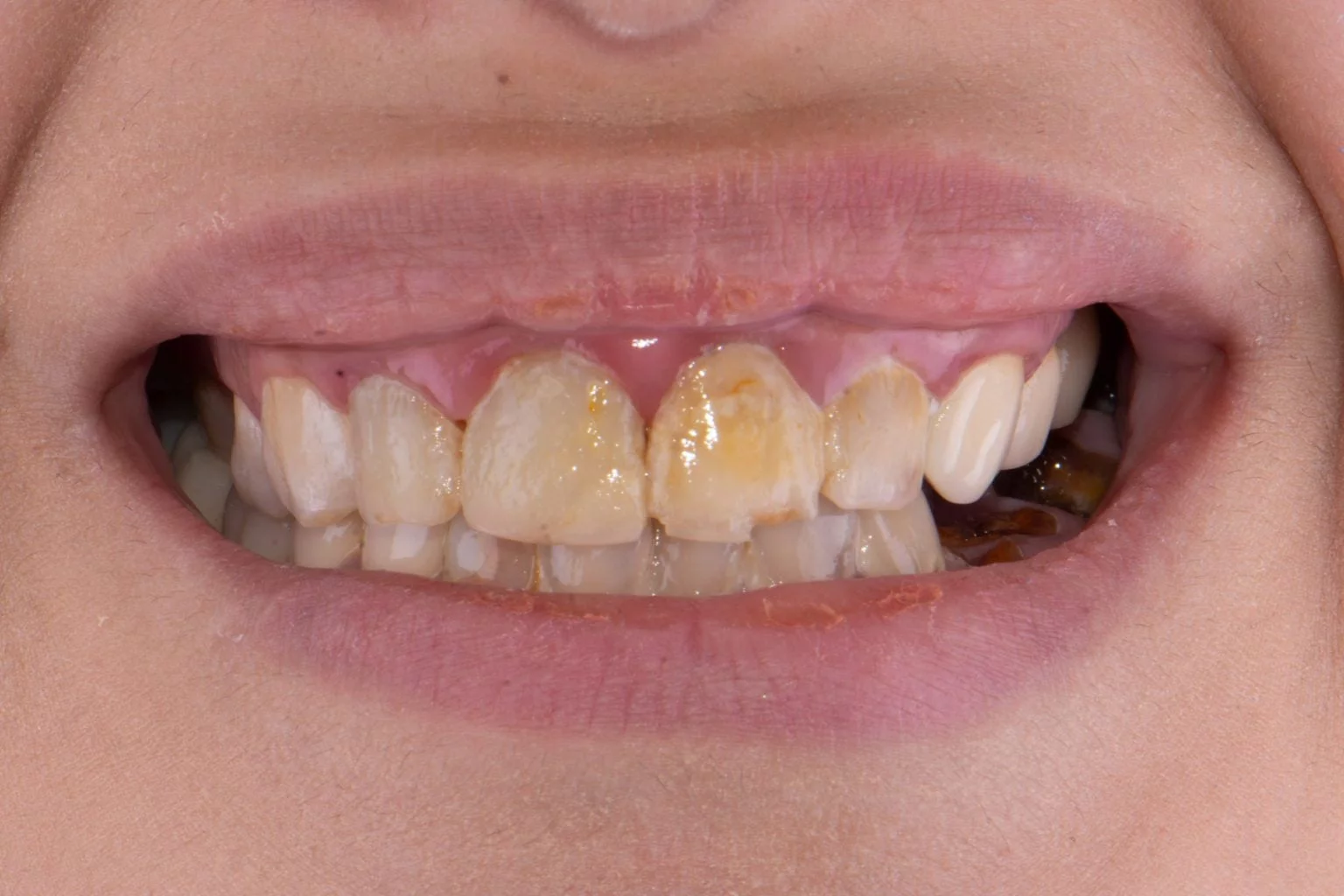 Before treatment