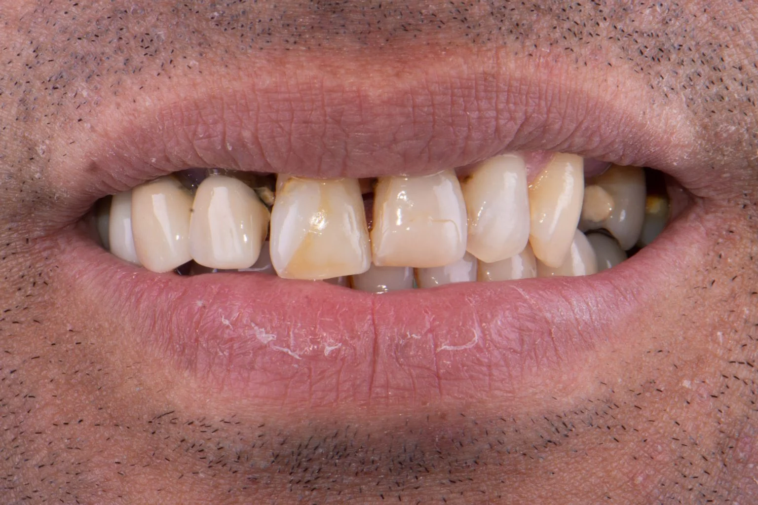 Before treatment