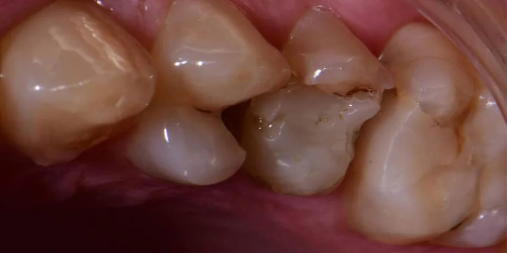 Before treatment