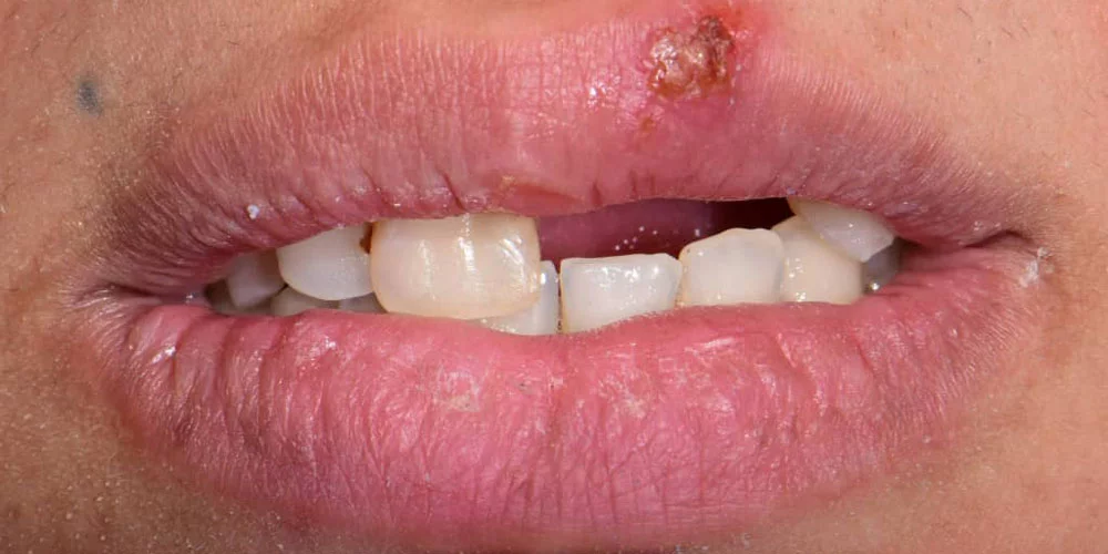 Before treatment