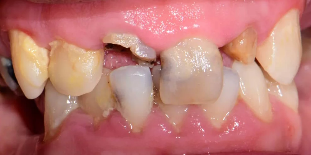 Before treatment