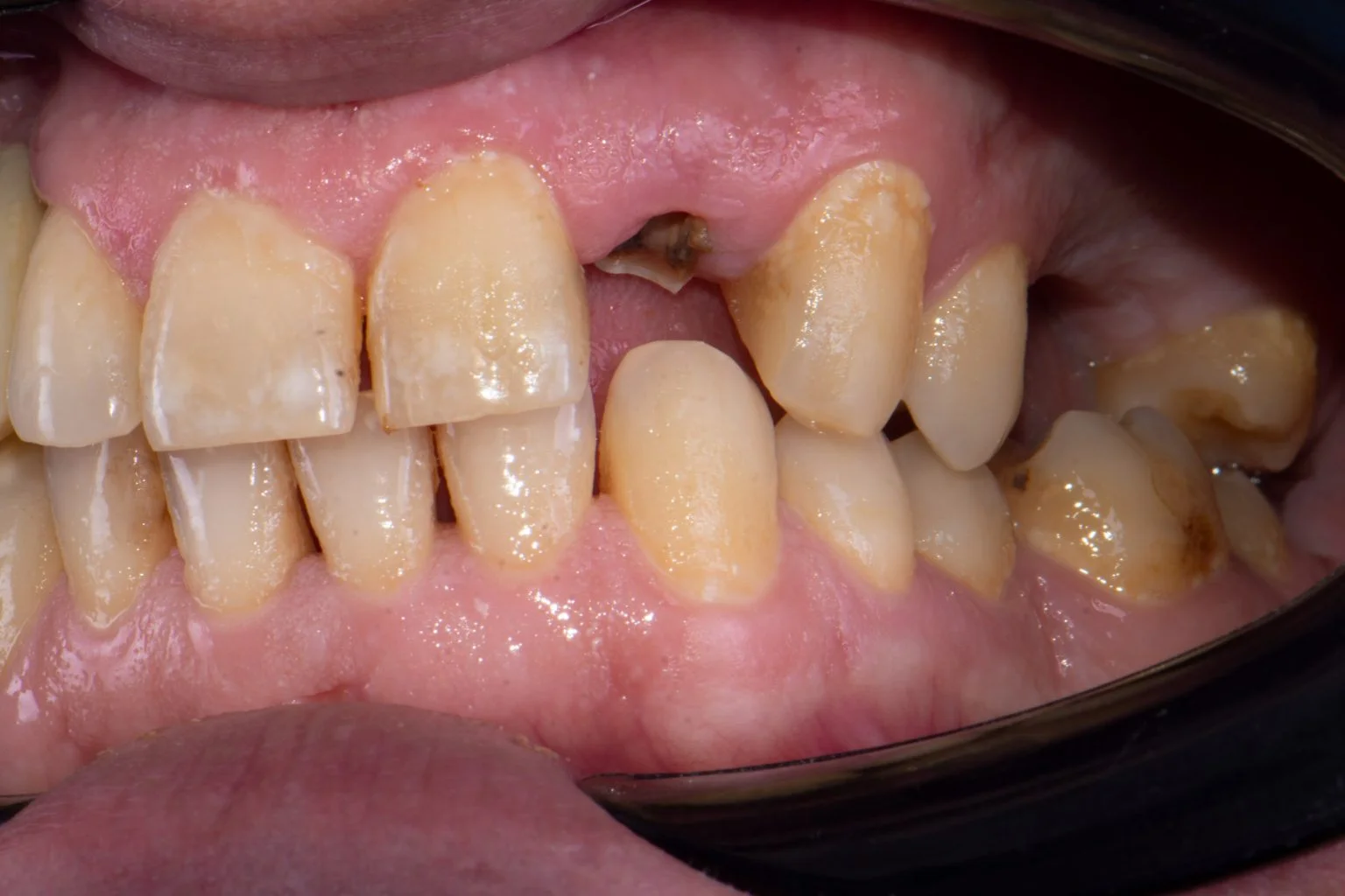 Before treatment