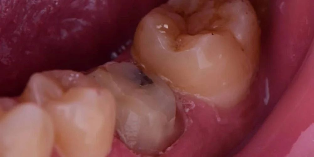 Before treatment