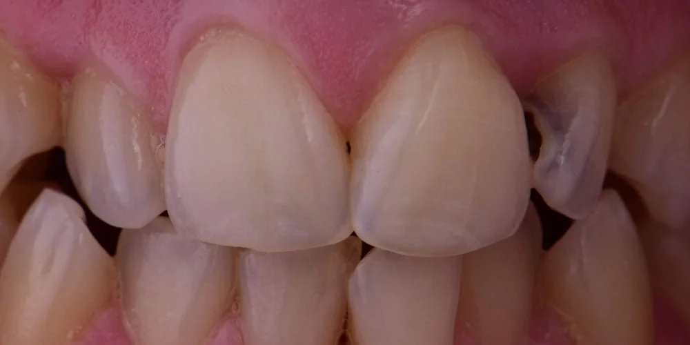 Before treatment