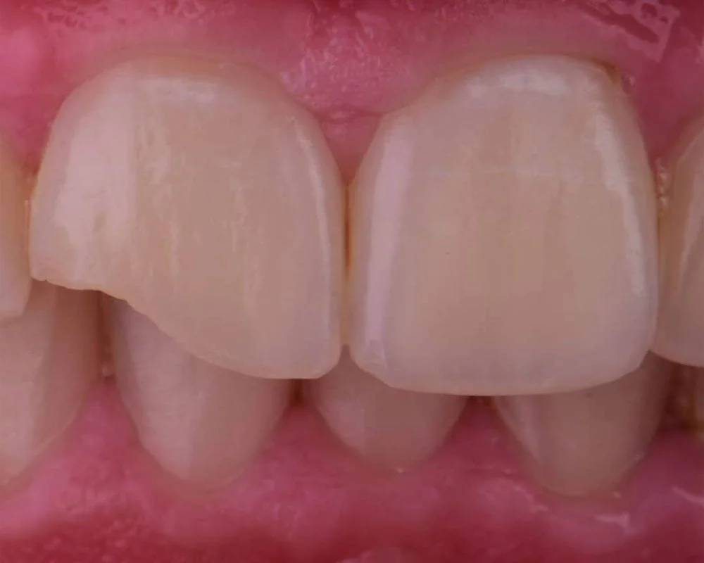 Before treatment