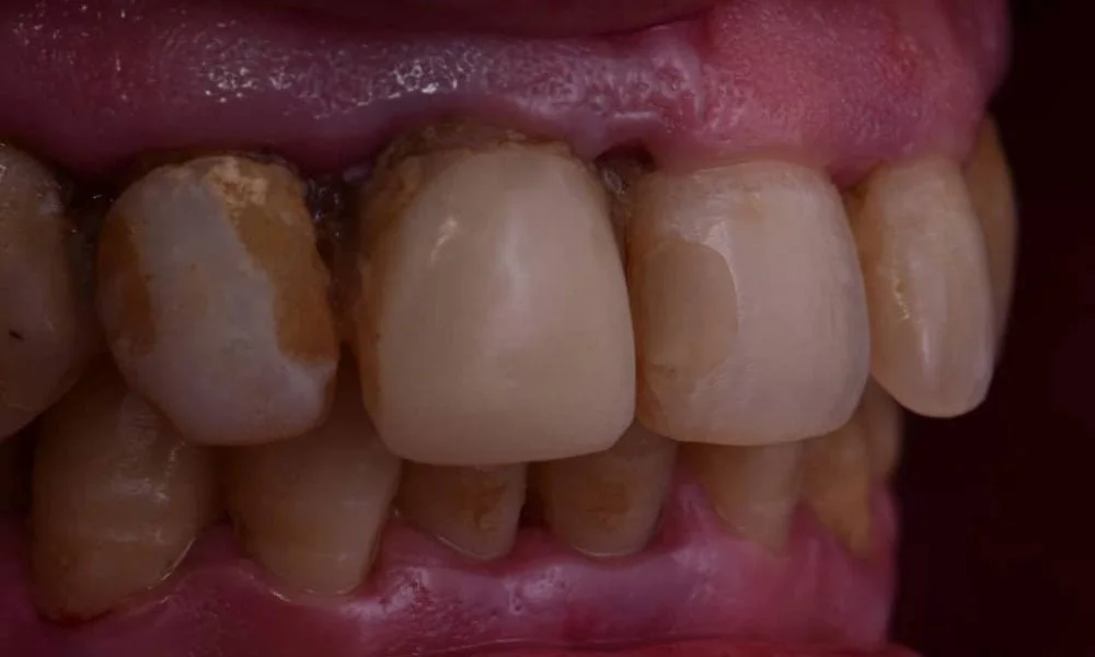 Before treatment