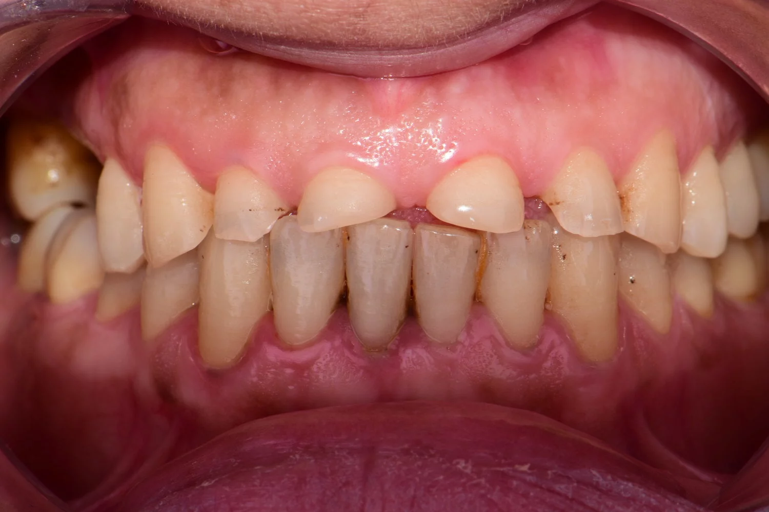 Before treatment