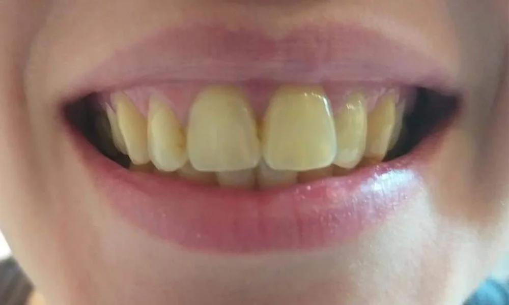 Before treatment