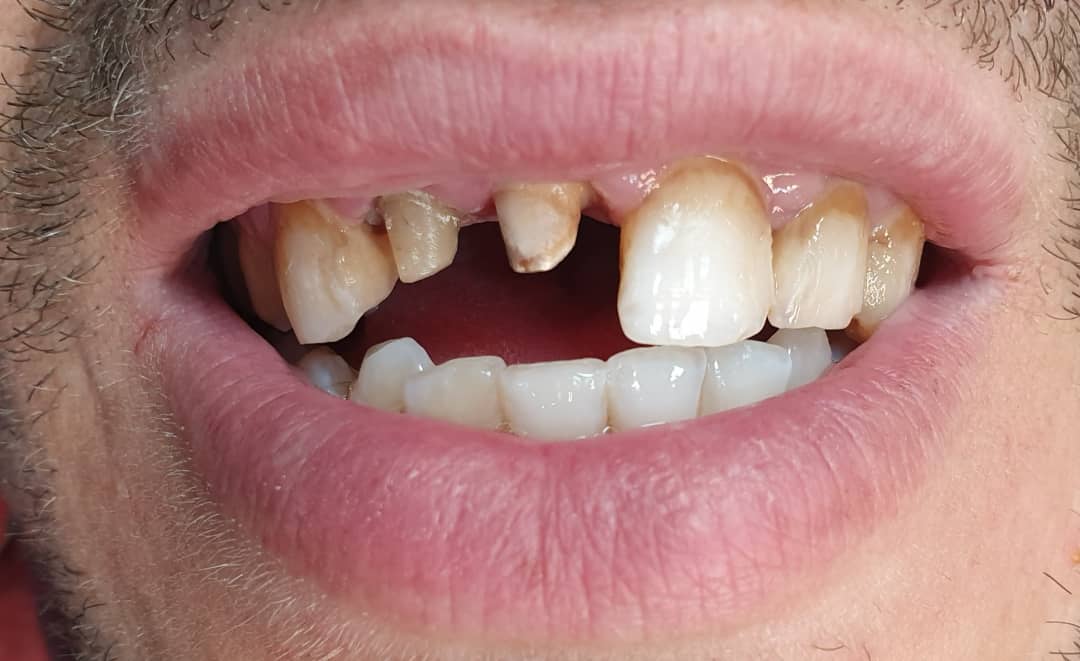 Before treatment