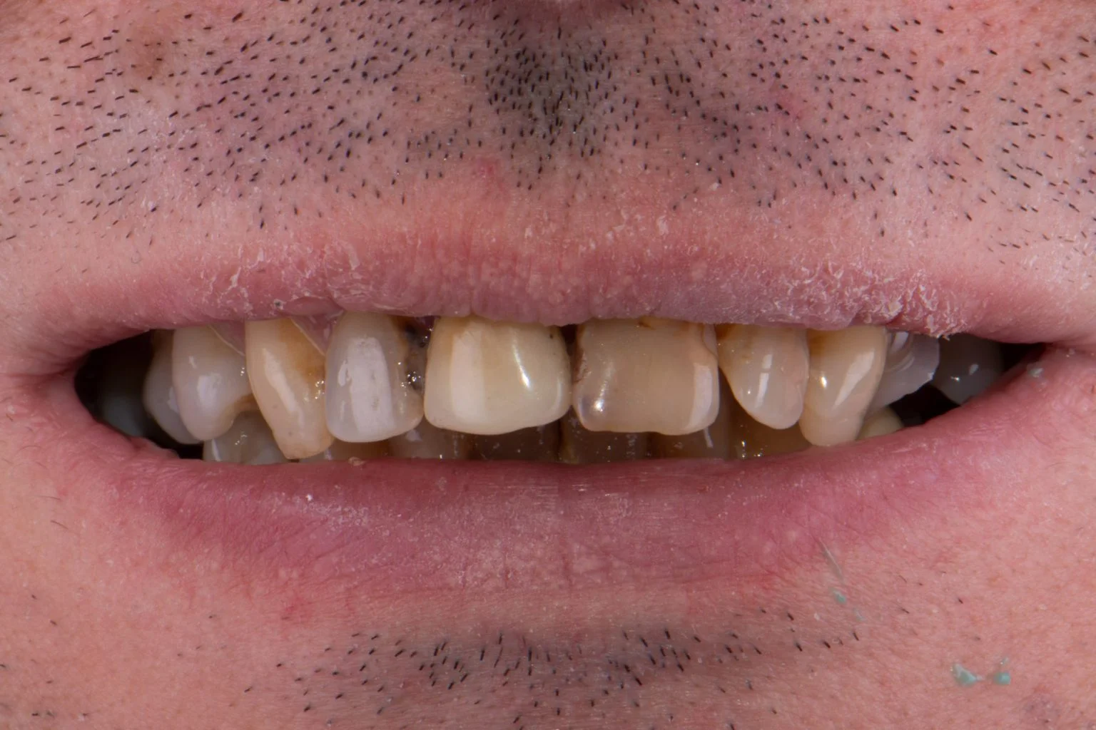 Before treatment
