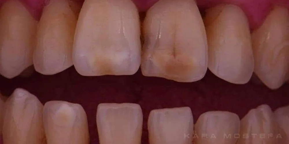 Before treatment