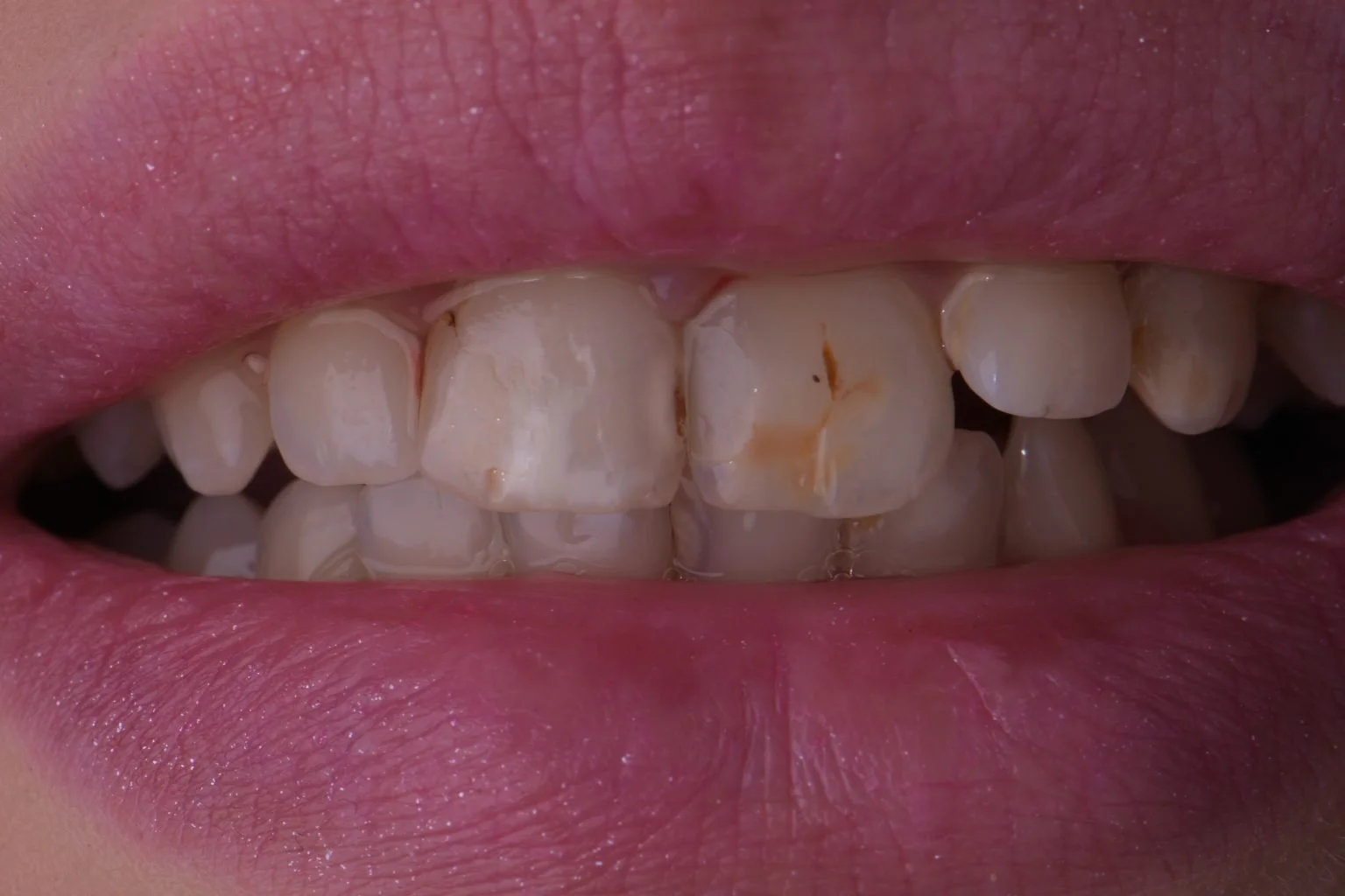 Before treatment