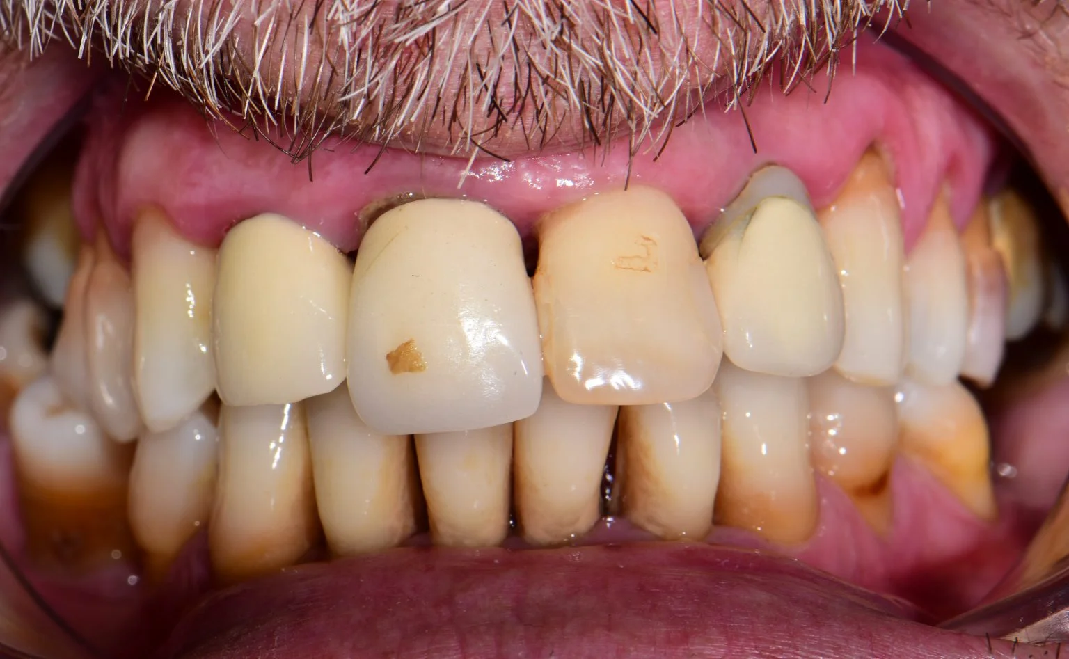 Before treatment