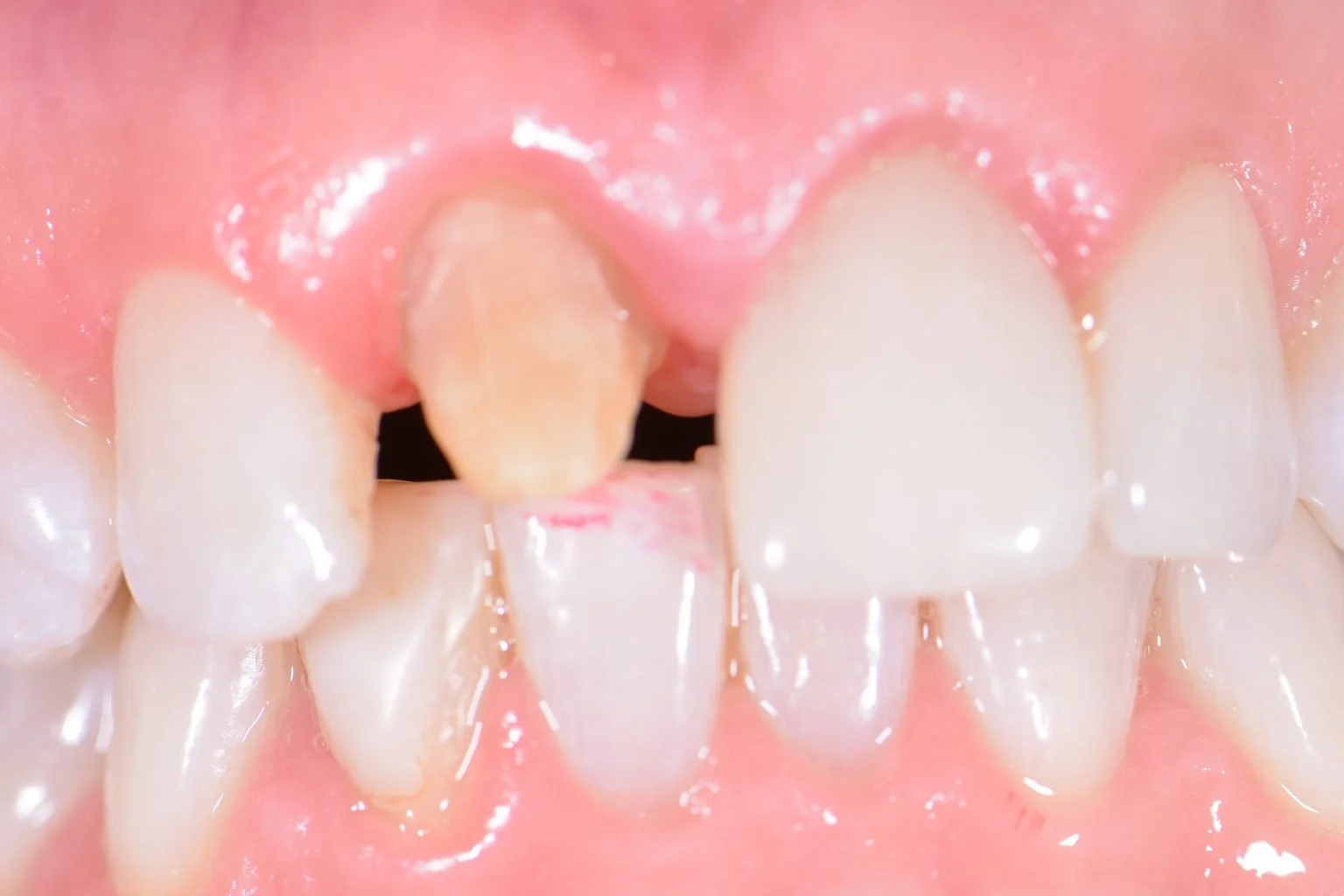 Before treatment