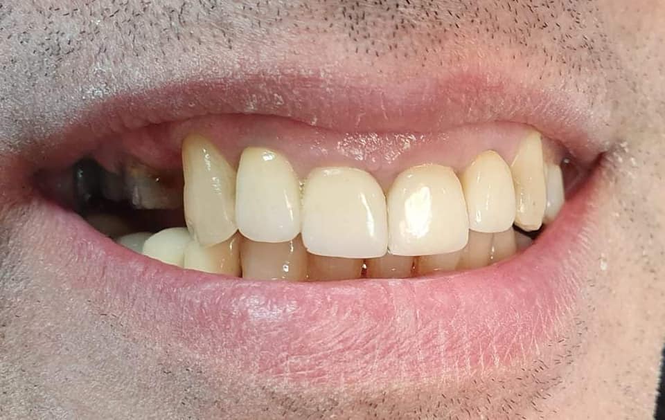 Before treatment