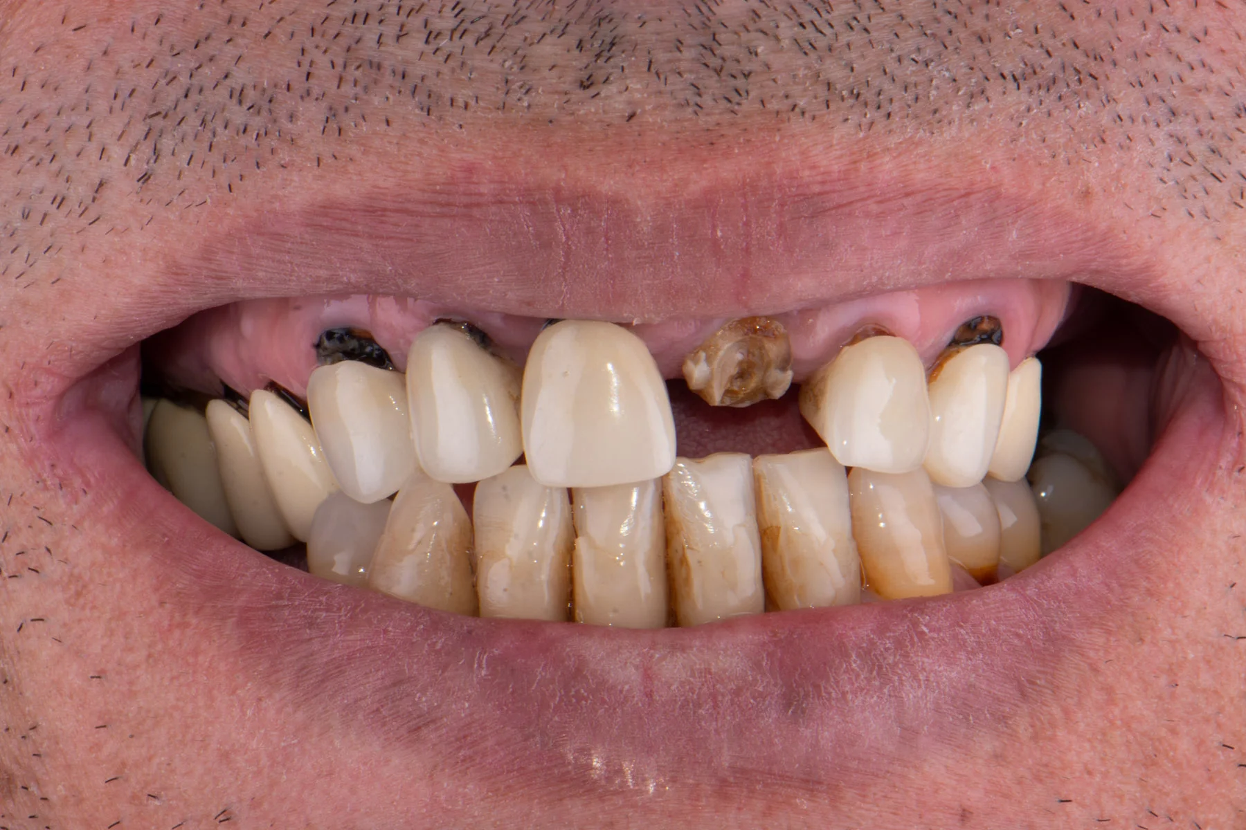 Before treatment