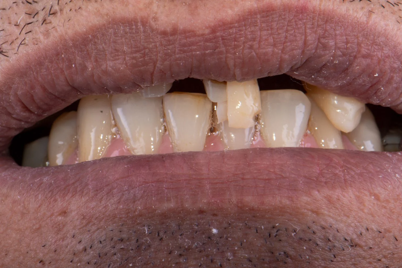 Before treatment