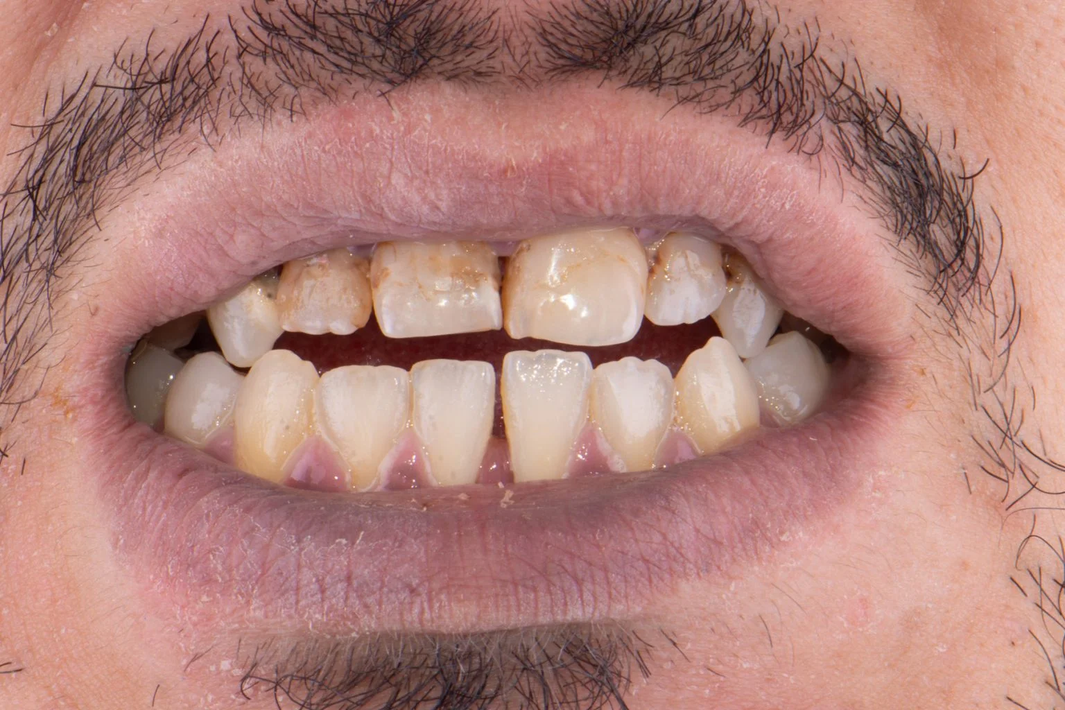 Before treatment