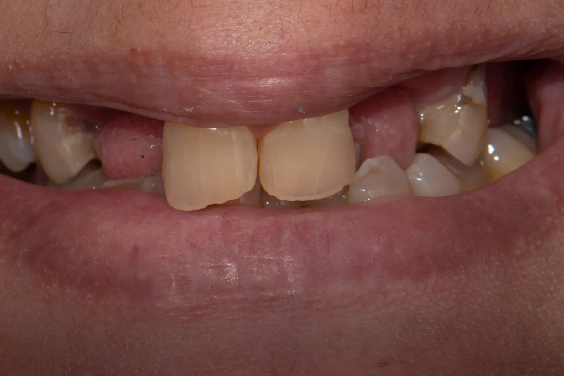 Before treatment
